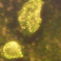 Gold nanoparticles stick to cancer cells and make them shine. Source: http://phys.org/news4023.html