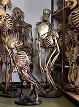 Skeletons affected by disease. Source: Museum Vrolik.  